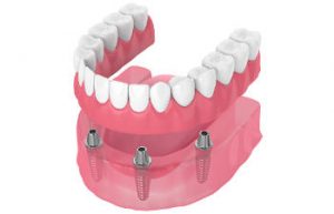 All-on-four dental implants