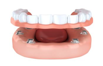 All-On-4 Implant Dentures