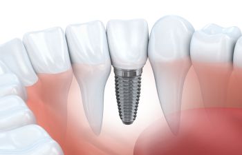 Dental Implant