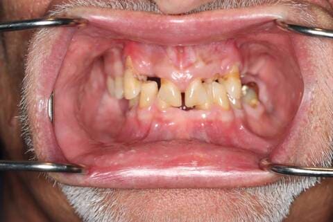 male patient before all on 4 dental implants procedure