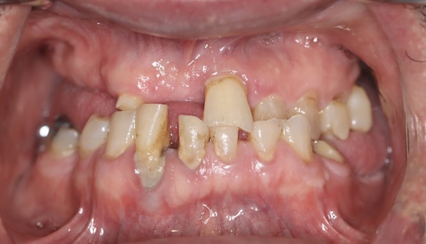 male patient before all on 4 dental implants procedure