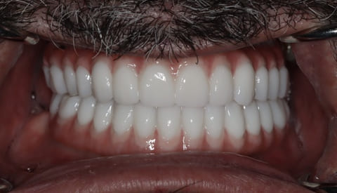 male patient before all on 4 dental implants procedure