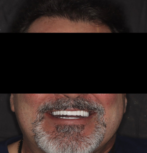 male patient before all on 4 dental implants procedure