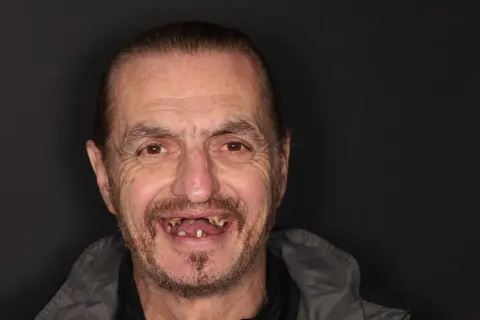 male patient before all on 4 dental implants procedure