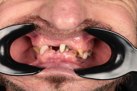 male patient before all on 4 dental implants procedure