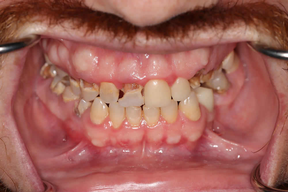 male patient before all on 4 dental implants procedure