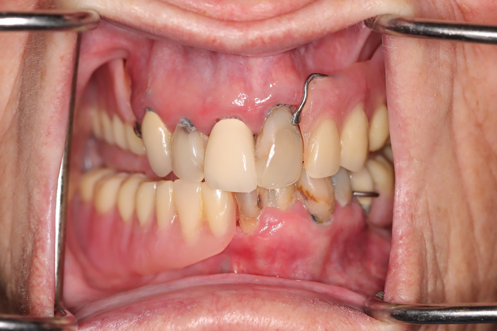 female patient before all on 4 dental implants procedure