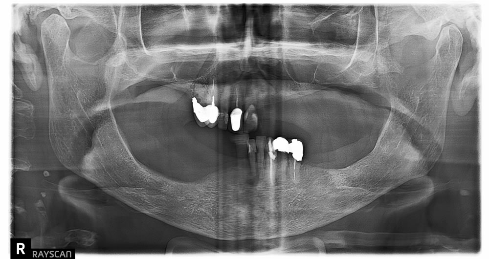 female patient before all on 4 dental implants procedure